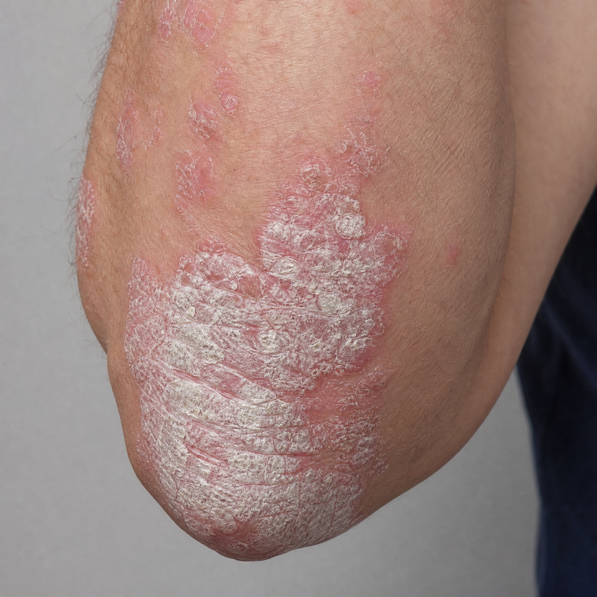 close-up of arm with plaque psoriasis plaques showing red scaly patches on elbow with soft clinical lighting