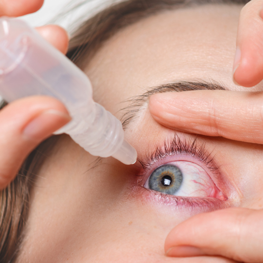 Dry Eye Syndrome